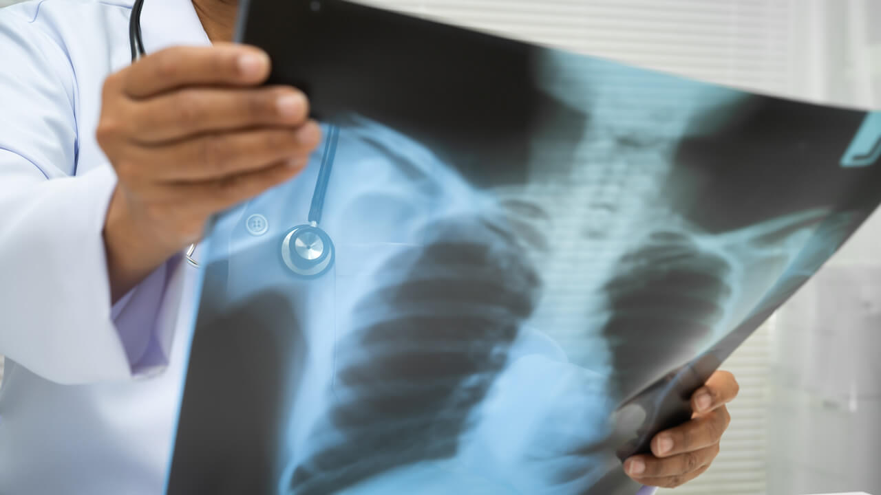 Fractura de costilla por accidente laboral en NY: guía
